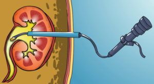 Нефроскопия в клинике ЦЭЛТ в Москве