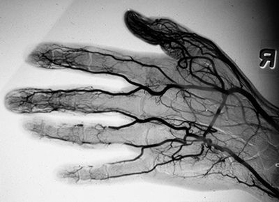 Компьютерно-томографическая ангиография сосудов верхних конечностей в клинике ЦЭЛТ в Москве