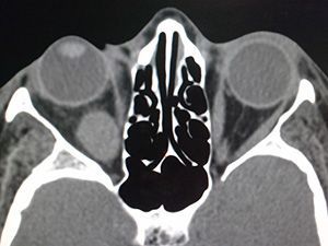 КТ орбит глаза в клинике ЦЭЛТ в Москве