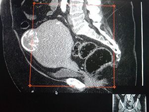Компьютерная томография органов малого таза с контрастированием в клинике ЦЭЛТ в Москве