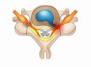 Фораминальная грыжа межпозвоночного диска в клинике ЦЭЛТ в Москве