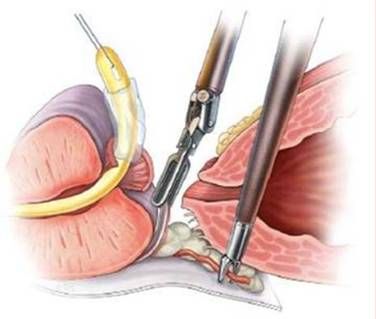 Лапароскопическая простатэктомия (I категория сложности) в клинике ЦЭЛТ в Москве