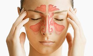 Синуситы (острые и хронические формы)