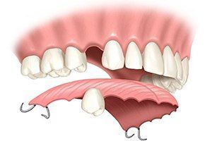 Изготовление полного съемного пластинчатого протеза «Ивокрил» в клинике ЦЭЛТ в Москве