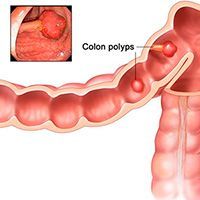 Доброкачественные заболевания толстой кишки