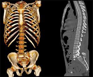 Компьютерная томография позвоночника в клинике ЦЭЛТ в Москве