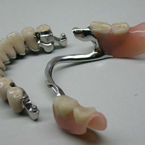 Изготовление штифтовой конструкции (фрикционный штифт) в клинике ЦЭЛТ в Москве