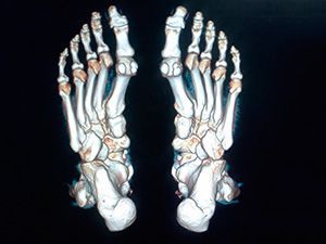 Компьютерная томография стопы в клинике ЦЭЛТ в Москве