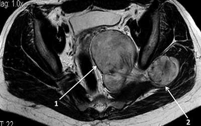 Опухоли шваннома
