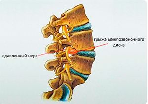 Операция при кистах позвоночного канала (синовиомы) (I категория сложности) в клинике ЦЭЛТ в Москве