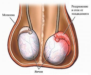 Эпидидимит