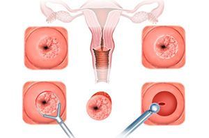 Дисплазия шейки матки