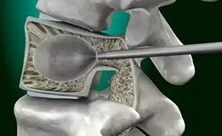 Операция при компрессионном переломе позвоночника в клинике ЦЭЛТ в Москве