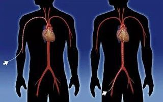 РЧА (радиочастотная катетерная абляция) в клинике ЦЭЛТ в Москве