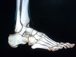 Компьютерная томография голеностопного сустава в клинике ЦЭЛТ в Москве