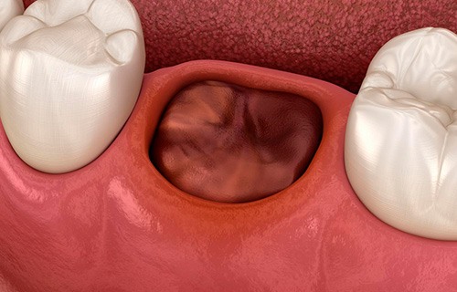 Медикаментозное лечение альвеолита в клинике ЦЭЛТ в Москве