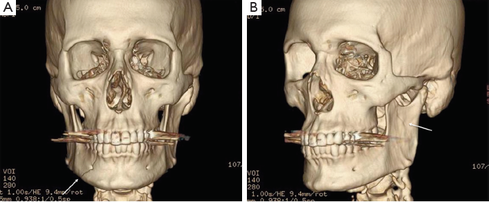 КТ левого предсердия и легочных вен в клинике ЦЭЛТ в Москве