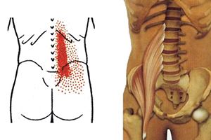Миотонический, миофасциальный болевой синдром