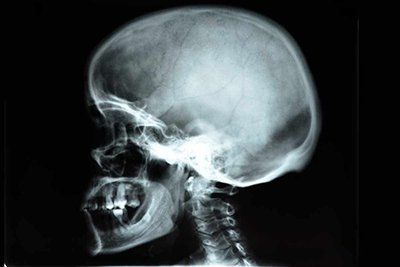 Рентген костей носа в клинике ЦЭЛТ в Москве