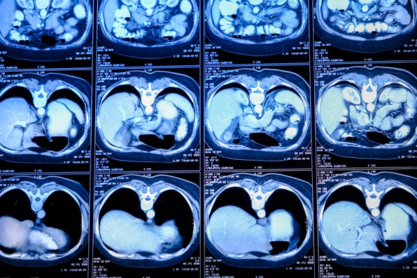 Компьютерно-томографическая ангиография брахиоцефальных артерий в клинике ЦЭЛТ в Москве