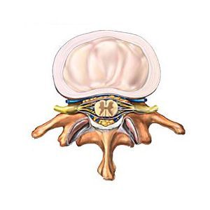 Протрузия дисков позвоночника поясничного отдела