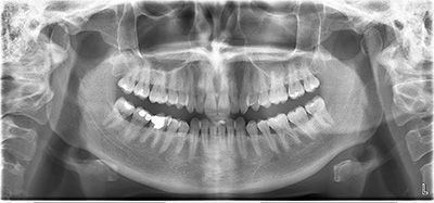 Ортопантомография (с выдачей результатов на CD-диске) в клинике ЦЭЛТ в Москве