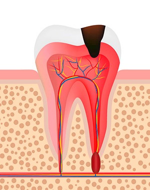 Цистотомия в клинике ЦЭЛТ в Москве