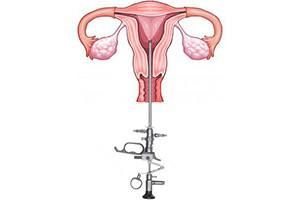 Гистероскопическая миомэктомия матки в клинике ЦЭЛТ в Москве
