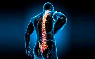 Синовиальные кисты позвоночного канала, синовиомы