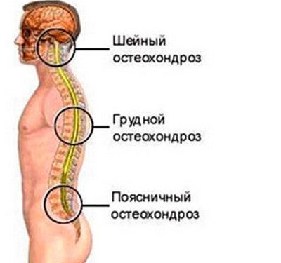 Поясничный остеохондроз позвоночника