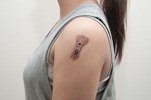 Онкозаболевания кожи (лейкоплакия, базалиома)