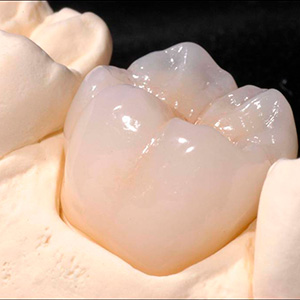 Коронки Empress в клинике ЦЭЛТ в Москве