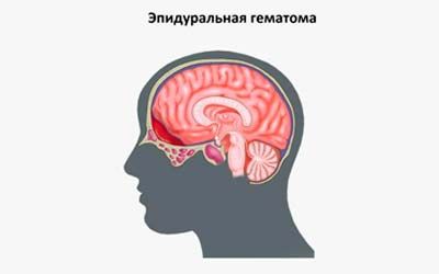 Эпидуральные гематомы головного мозга
