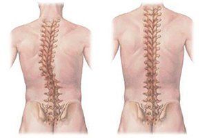 Сколиоз позвоночника 3 степени