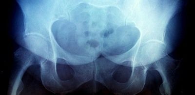 Рентгенография тазобедренного сустава в клинике ЦЭЛТ в Москве