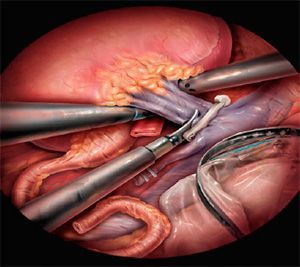 Лапароскопическая нефрэктомия (I категория сложности) в клинике ЦЭЛТ в Москве