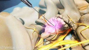 Радиочастотная денервация фасеточных суставов в клинике ЦЭЛТ в Москве