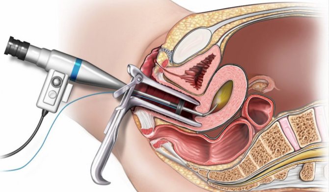 Удаление перегородки влагалища (I категория сложности) в клинике ЦЭЛТ в Москве