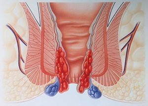 Радикальная геморроидэктомия (I категория сложности) в клинике ЦЭЛТ в Москве