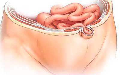 Пупочные грыжи