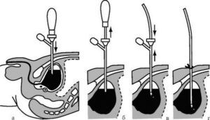 Троакарная цистостомия (I категория сложности) в клинике ЦЭЛТ в Москве