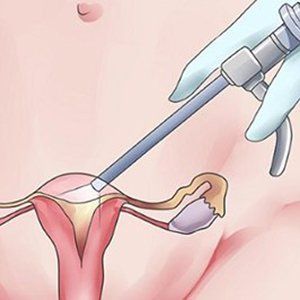Субтотальная лапаротомическая гистерэктомия матки с придатками в клинике ЦЭЛТ в Москве