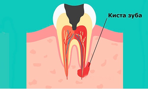 Цистэктомия в клинике ЦЭЛТ в Москве
