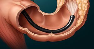 Колоноскопия (видеоколоноскопия) под наркозом с подготовкой в стационаре, включая пребывание в двухместной палате, консультацию терапевта, консультацию анестезиолога, анестезиологическое пособие в клинике ЦЭЛТ в Москве