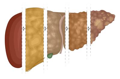 Цироз печени