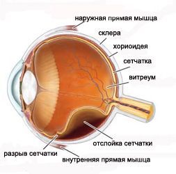 Отслойка сетчатки