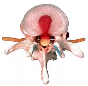 Медианная грыжа межпозвоночных дисков в клинике ЦЭЛТ в Москве