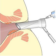 Склеротерапия геморроидальных узлов в клинике ЦЭЛТ в Москве