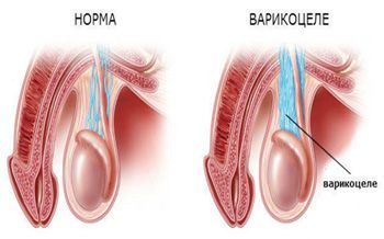 Варикоцеле