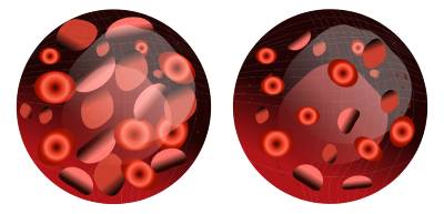 Фолиеводефицитная анемия